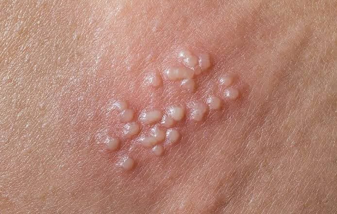 ALERTA SANITARIA POR BROTE DE HERPES GENITAL