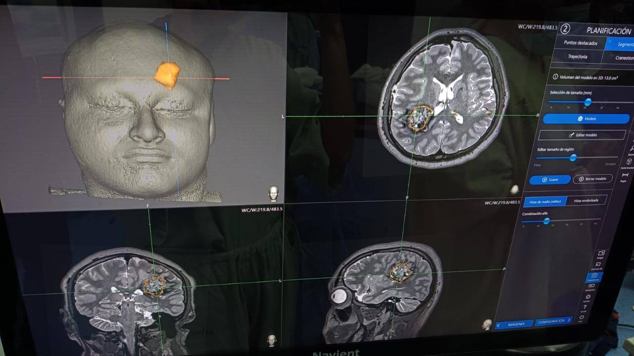 🧠✨ Histórico avance médico en Yucatán: IMSS realiza la primera cirugía cerebral en adolescente despierto 🇲🇽💪